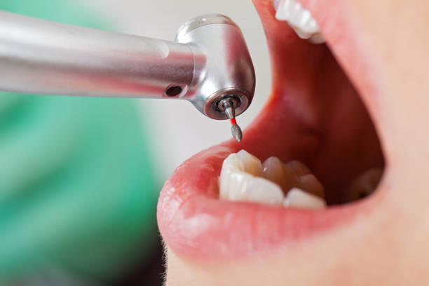 Best Dentist for Tooth Abscess  in Calhoun, GA